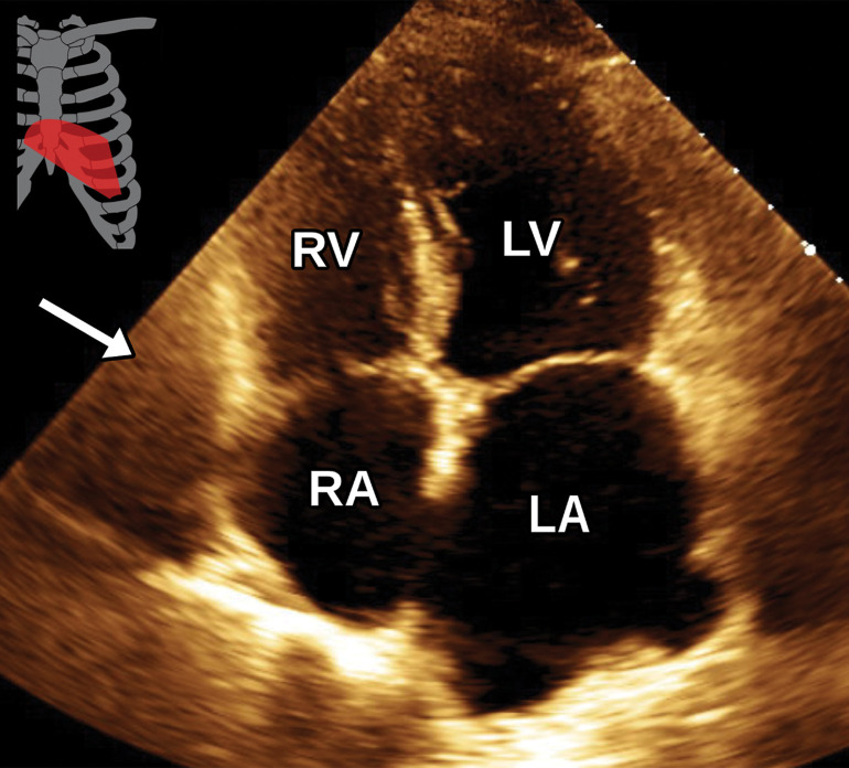 Pericardial cyst incidentally detected in a 67-year-old man without an acute complaint who underwent TTE and noncontrast chest CT within 2 weeks of each other. (a) Axial noncontrast chest CT image shows a circumscribed simple fluid-attenuation mass (arrow) at the right anterior cardiophrenic angle. No definite pericardial cyst was seen at TTE. (b) Apical four-chamber TTE view shows a questionable subtle hypoechoic structure possibly representing a cyst (arrow), which was seen retrospectively.