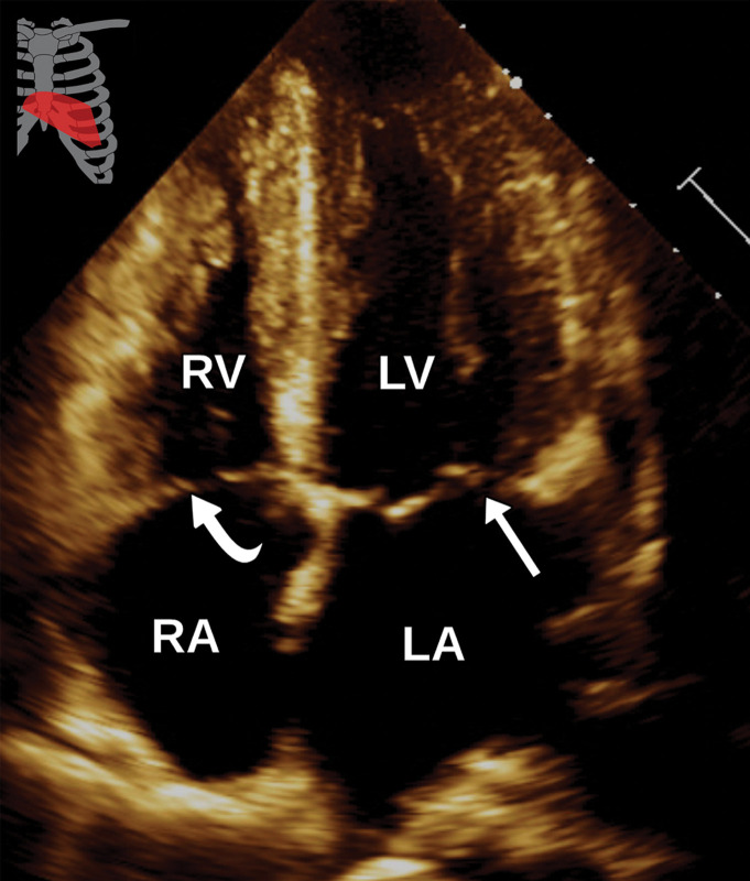 Normal apical four-chamber view at TTE (a) and correlative cardiac CTA (b). Owing to the parallel orientation of the interatrial septum to the ultra-sound beam, an atrial septal defect may be simulated where no actual defect is present. Additionally, valve leaflets may be difficult to visualize on cardiac CTA images. Straight arrow = mitral valve, curved arrow = tricuspid valve.