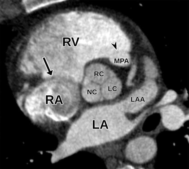 Normal parasternal short-axis view at the aortic valve level at TTE (a) and correlative cardiac CTA (b). LAA = left atrial appendage, LC = left coronary cusp, MPA = main pulmonary artery, NC = noncoronary cusp, RC = right coronary cusp, arrow = tricuspid valve, arrowhead = pulmonary valve.