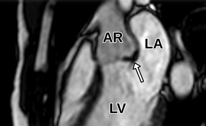 Aortic valve vegetation in a 58-year-old man with septicemia and a history of prior septic emboli to the brain. (a) Axial CTA image of the aortic valve shows an irregular vegetation of the noncoronary cusp (arrow). (b) Sagittal oblique (three-chamber) white-blood SSFP MR image shows the irregular vegetation involving the noncoronary cusp (arrow). AR = aortic root. (c, d) Parasternal long-axis (c) and short-axis (d) TTE views through the level of the aortic valve (arrow in c, AV in d) show normal-appearing leaflets without definite thickening or vegetation. The imaging findings in this clinical setting are consistent with infective endocarditis. LVOT in c = LV outflow tract.