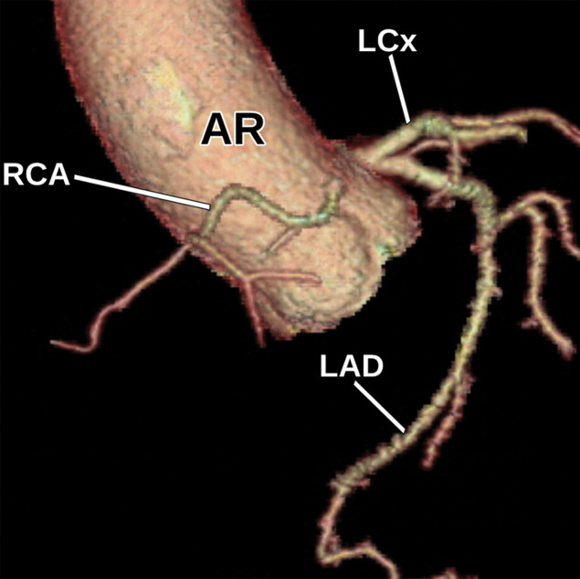 Anomalous coronary artery in a 63-year-old woman who underwent TTE for a 2-month history of chest pain. (a) Parasternal short-axis TTE image at the level of the aortic valve shows that the origins of the coronary arteries can be difficult to identify at TTE. The remainder of the TTE was notable only for borderline concentric LV hypertrophy and mild LA enlargement. LC = left coronary cusp, NC = noncoronary cusp, RC = right coronary cusp. (b, c) Reconstructed axial oblique (b) and volume-rendered (c) images from cardiac CTA of the coronary arteries show anomalous origin of the right coronary artery (straight arrow in b, RCA in c) from the left coronary cusp with an interarterial course. AR = aortic root, curved arrow in b = left main coronary artery, arrowhead in b = pulmonary valve, LAD in c = left anterior descending coronary artery, LCx in c = left circumflex coronary artery. (d, e) Selected images from subsequent nongated CTA of the chest, abdomen, and pelvis show the anomalous origin of the right coronary artery (black arrow in e) from the left coronary cusp. AR = aortic root, * = RV outflow tract, arrow in d = left main coronary artery, white arrow in e = left circumflex coronary artery. This case highlights the fact that anomalous coronary arteries may not be detected at TTE and are occasionally discovered at nongated chest CT.