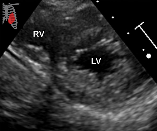 Normal parasternal short-axis view at the LV apex level at TTE (a) and correlative cardiac CTA (b). In this example, the RV is visible in addition to the LV, although this is not required.
