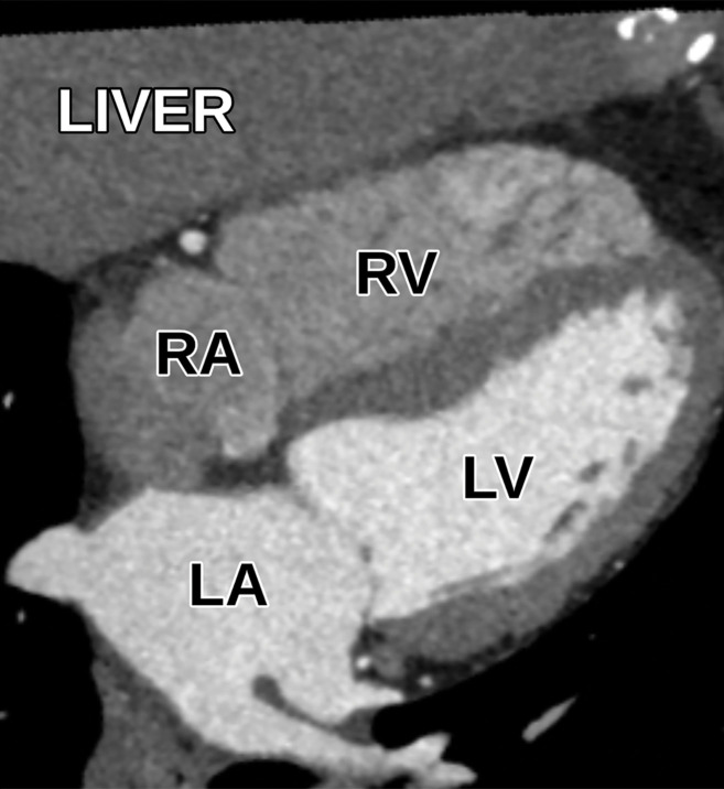 Normal subcostal four-chamber view at TTE (a) and correlative cardiac CTA (b).