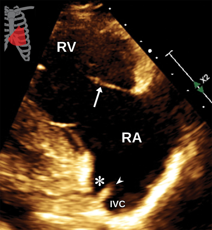 Normal parasternal long-axis RV inflow view at TTE (a) and correlative cardiac CTA (b). IVC = inferior vena cava, arrow = tricuspid valve, arrowhead = eustachian valve, * = coronary sinus.