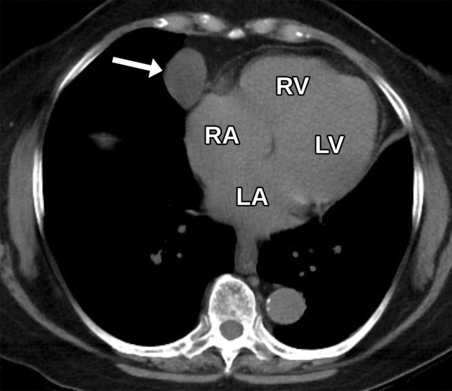 Pericardial cyst incidentally detected in a 67-year-old man without an acute complaint who underwent TTE and noncontrast chest CT within 2 weeks of each other. (a) Axial noncontrast chest CT image shows a circumscribed simple fluid-attenuation mass (arrow) at the right anterior cardiophrenic angle. No definite pericardial cyst was seen at TTE. (b) Apical four-chamber TTE view shows a questionable subtle hypoechoic structure possibly representing a cyst (arrow), which was seen retrospectively.