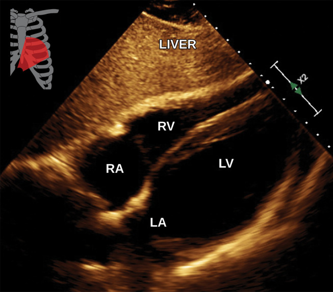 Normal subcostal four-chamber view at TTE (a) and correlative cardiac CTA (b).