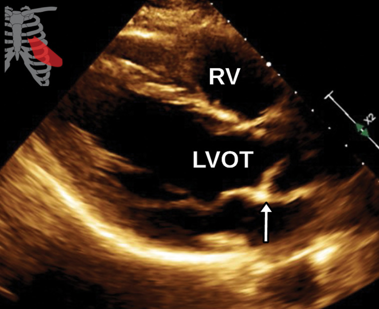 Aortic valve vegetation in a 58-year-old man with septicemia and a history of prior septic emboli to the brain. (a) Axial CTA image of the aortic valve shows an irregular vegetation of the noncoronary cusp (arrow). (b) Sagittal oblique (three-chamber) white-blood SSFP MR image shows the irregular vegetation involving the noncoronary cusp (arrow). AR = aortic root. (c, d) Parasternal long-axis (c) and short-axis (d) TTE views through the level of the aortic valve (arrow in c, AV in d) show normal-appearing leaflets without definite thickening or vegetation. The imaging findings in this clinical setting are consistent with infective endocarditis. LVOT in c = LV outflow tract.