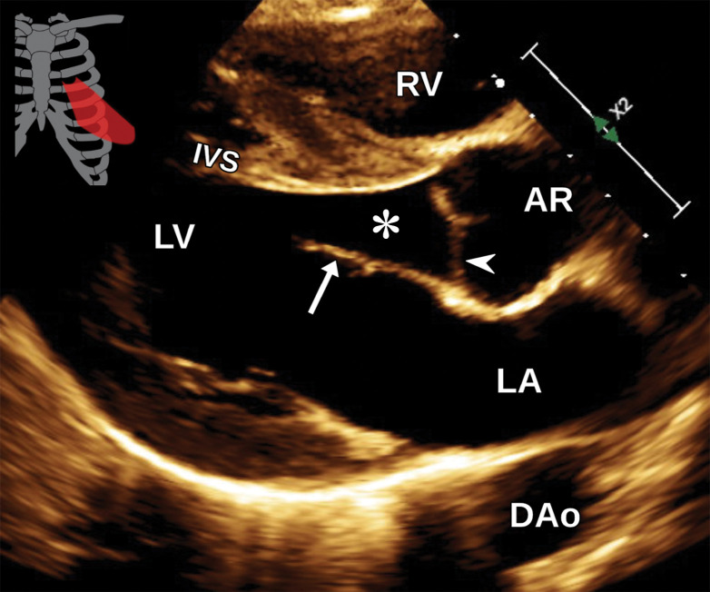 Normal parasternal long-axis LV view at TTE (a) and correlative cardiac CT angiography (CTA) (b). AR = aortic root, DAo = descending aorta, IVS = interventricular septum, LA = left atrium, arrow = mitral valve, arrowhead = aortic valve, * = LV outflow tract.