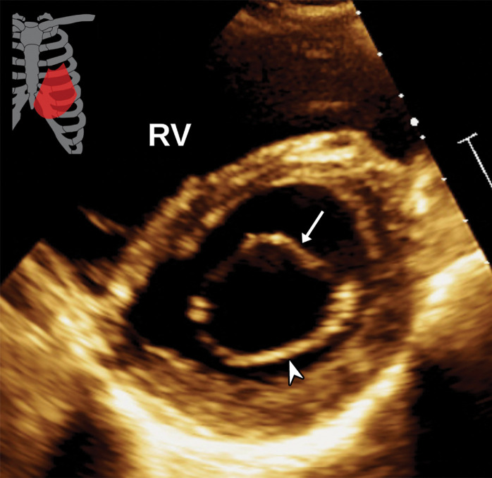 Normal parasternal short-axis view at the mitral valve level in diastole at TTE (a) and correlative cardiac CTA (b). Arrow = anterior mitral valve leaflet, arrowhead = posterior mitral valve leaflet.