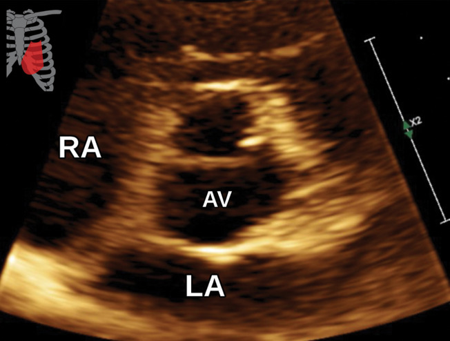 Aortic valve vegetation in a 58-year-old man with septicemia and a history of prior septic emboli to the brain. (a) Axial CTA image of the aortic valve shows an irregular vegetation of the noncoronary cusp (arrow). (b) Sagittal oblique (three-chamber) white-blood SSFP MR image shows the irregular vegetation involving the noncoronary cusp (arrow). AR = aortic root. (c, d) Parasternal long-axis (c) and short-axis (d) TTE views through the level of the aortic valve (arrow in c, AV in d) show normal-appearing leaflets without definite thickening or vegetation. The imaging findings in this clinical setting are consistent with infective endocarditis. LVOT in c = LV outflow tract.