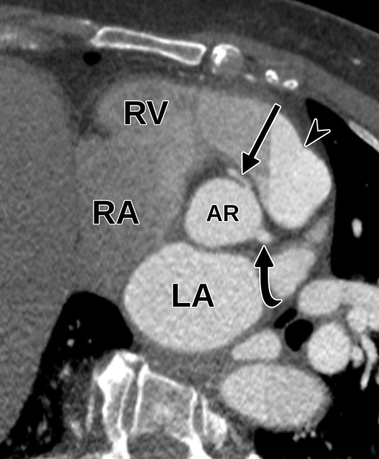Anomalous coronary artery in a 63-year-old woman who underwent TTE for a 2-month history of chest pain. (a) Parasternal short-axis TTE image at the level of the aortic valve shows that the origins of the coronary arteries can be difficult to identify at TTE. The remainder of the TTE was notable only for borderline concentric LV hypertrophy and mild LA enlargement. LC = left coronary cusp, NC = noncoronary cusp, RC = right coronary cusp. (b, c) Reconstructed axial oblique (b) and volume-rendered (c) images from cardiac CTA of the coronary arteries show anomalous origin of the right coronary artery (straight arrow in b, RCA in c) from the left coronary cusp with an interarterial course. AR = aortic root, curved arrow in b = left main coronary artery, arrowhead in b = pulmonary valve, LAD in c = left anterior descending coronary artery, LCx in c = left circumflex coronary artery. (d, e) Selected images from subsequent nongated CTA of the chest, abdomen, and pelvis show the anomalous origin of the right coronary artery (black arrow in e) from the left coronary cusp. AR = aortic root, * = RV outflow tract, arrow in d = left main coronary artery, white arrow in e = left circumflex coronary artery. This case highlights the fact that anomalous coronary arteries may not be detected at TTE and are occasionally discovered at nongated chest CT.