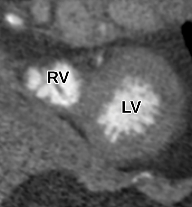 Normal parasternal short-axis view at the LV apex level at TTE (a) and correlative cardiac CTA (b). In this example, the RV is visible in addition to the LV, although this is not required.