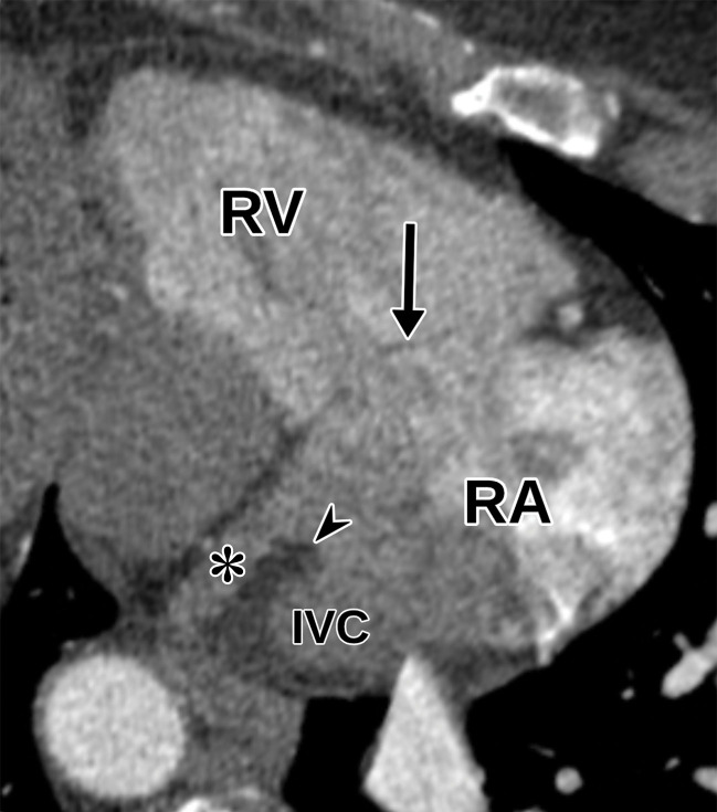 Normal parasternal long-axis RV inflow view at TTE (a) and correlative cardiac CTA (b). IVC = inferior vena cava, arrow = tricuspid valve, arrowhead = eustachian valve, * = coronary sinus.