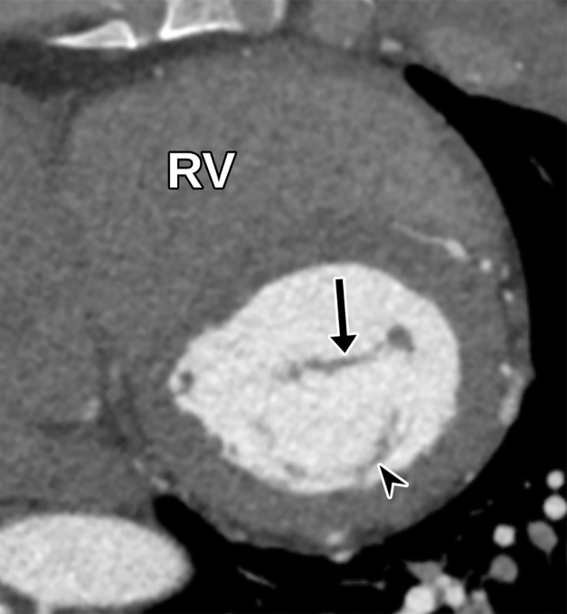 Normal parasternal short-axis view at the mitral valve level in diastole at TTE (a) and correlative cardiac CTA (b). Arrow = anterior mitral valve leaflet, arrowhead = posterior mitral valve leaflet.
