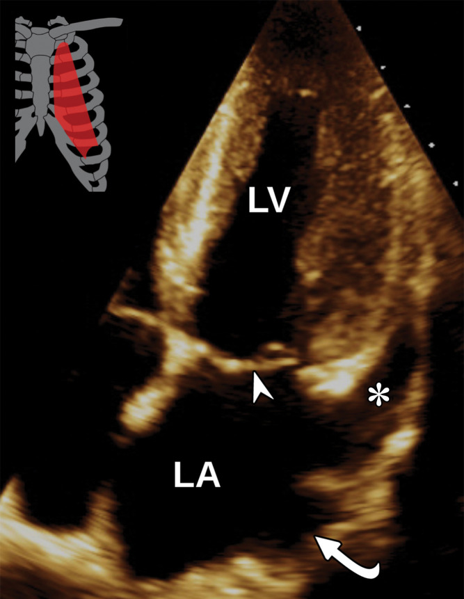 Normal apical two-chamber view at TTE (a) and correlative cardiac CTA (b). Arrowhead = mitral valve, * =