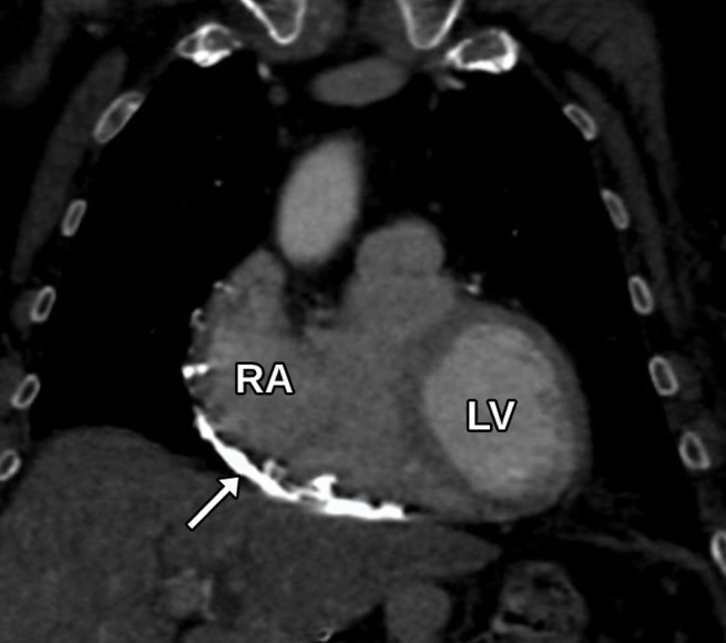 Pericardial calcifications in a 57-year-old man with chronic orthopnea and dyspnea, suggestive of constrictive pericarditis. (a, b) Axial (a) and coronal (b) cardiac CTA images of the chest show pericardial calcifications, most notable along the RV (arrow) and adjacent to the mitral valve (arrowhead in a). (c) Apical four-chamber TTE view shows a hyperechoic lesion (arrow) adjacent to the mitral valve, which was seen only in retrospect. The echogenic appearance is most consistent with calcification, although prominent fat in the atrioventricular groove can have a similar appearance. The true extent of pericardial calcification is visualized much better at CT.