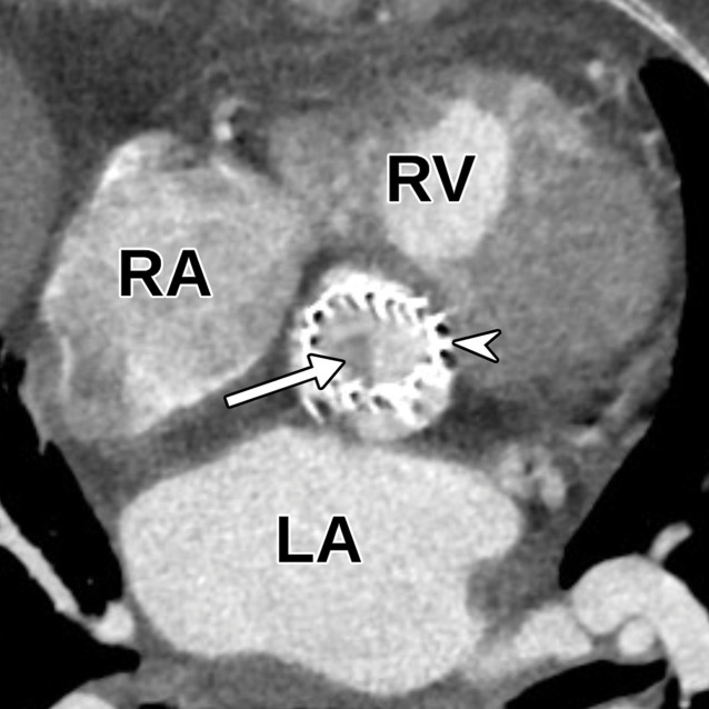 Hypoattenuating leaflet thickening (HALT) in a 62-year-old woman with a history significant for transcatheter aortic valve replacement (TAVR) secondary to aortic insufficiency. (a) Axial oblique CTA image of the aortic valve shows a metallic TAVR with appropriate positioning (arrowhead). The noncoronary leaflet is notably thickened with hypoattenuating material (arrow) present. (b, c) Parasternal short-axis (b) and long-axis (c) TTE views through the aortic valve show poor characterization of the valve prosthesis secondary to the echogenic nature of metal and posterior acoustic shadowing (arrow) without definite correlation with the CT finding. The patient had no clinical signs of infection and was subsequently diagnosed with HALT.