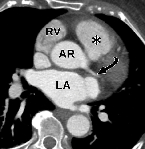Anomalous coronary artery in a 63-year-old woman who underwent TTE for a 2-month history of chest pain. (a) Parasternal short-axis TTE image at the level of the aortic valve shows that the origins of the coronary arteries can be difficult to identify at TTE. The remainder of the TTE was notable only for borderline concentric LV hypertrophy and mild LA enlargement. LC = left coronary cusp, NC = noncoronary cusp, RC = right coronary cusp. (b, c) Reconstructed axial oblique (b) and volume-rendered (c) images from cardiac CTA of the coronary arteries show anomalous origin of the right coronary artery (straight arrow in b, RCA in c) from the left coronary cusp with an interarterial course. AR = aortic root, curved arrow in b = left main coronary artery, arrowhead in b = pulmonary valve, LAD in c = left anterior descending coronary artery, LCx in c = left circumflex coronary artery. (d, e) Selected images from subsequent nongated CTA of the chest, abdomen, and pelvis show the anomalous origin of the right coronary artery (black arrow in e) from the left coronary cusp. AR = aortic root, * = RV outflow tract, arrow in d = left main coronary artery, white arrow in e = left circumflex coronary artery. This case highlights the fact that anomalous coronary arteries may not be detected at TTE and are occasionally discovered at nongated chest CT.