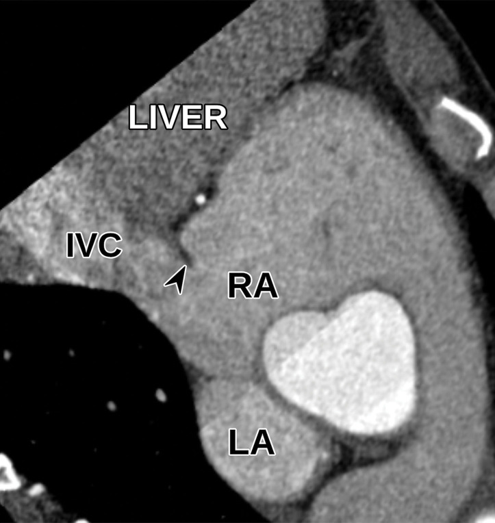 Normal subcostal inferior vena cava (IVC) view at TTE (a) and correlative cardiac CTA (b). Arrowhead = eustachian valve.