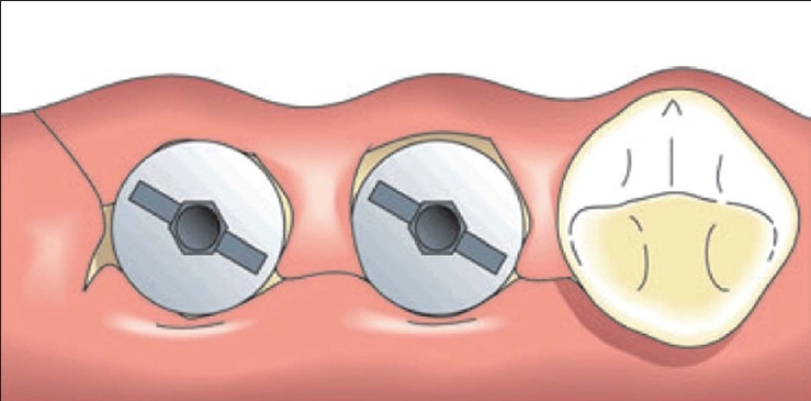 Figure 1c