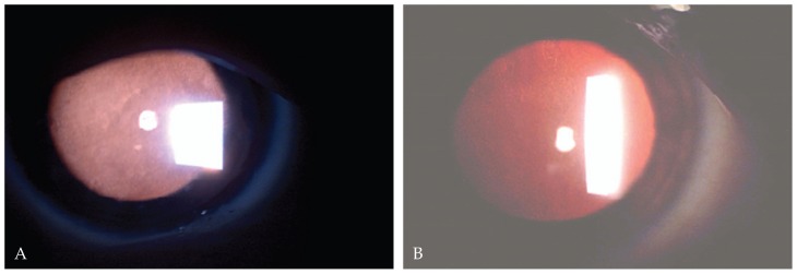 Meesmann Corneal Dystrophy; a Clinico-Pathologic, Ultrastructural and ...