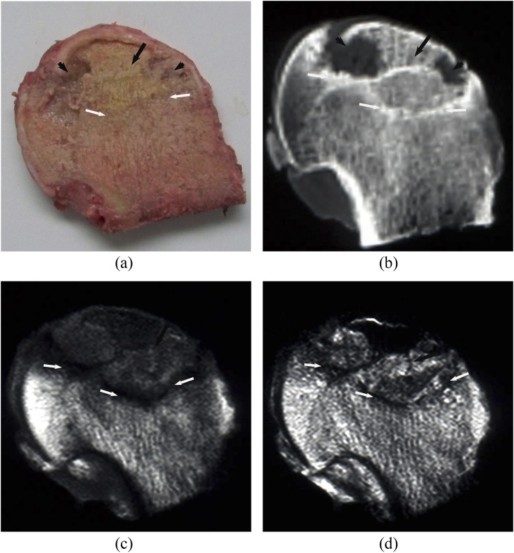 Osteonecrosis of the femoral head: using CT, MRI and gross specimen to ...