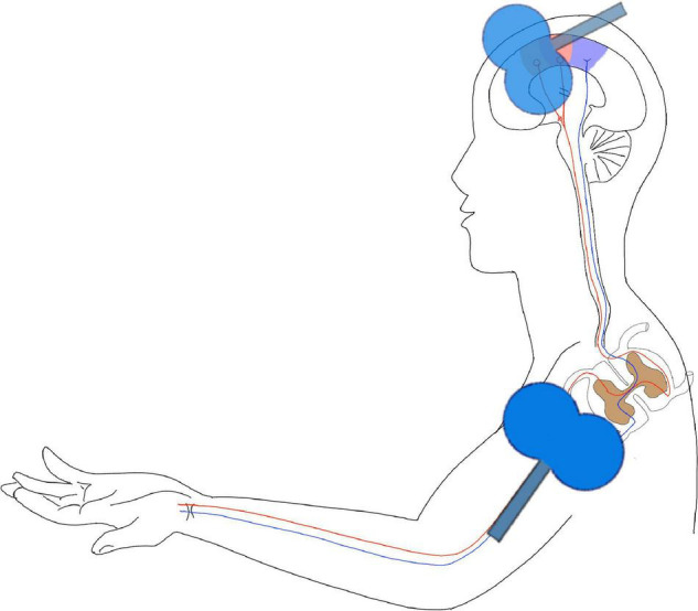 Using Hebbian-type Stimulation To Rescue Arm Function After Stroke 