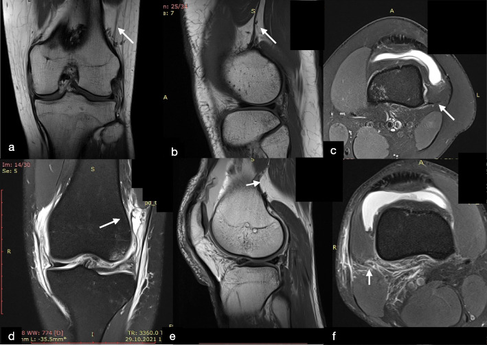 Distal Kaplan Fibers And Anterolateral Ligament Injuries Are Associated