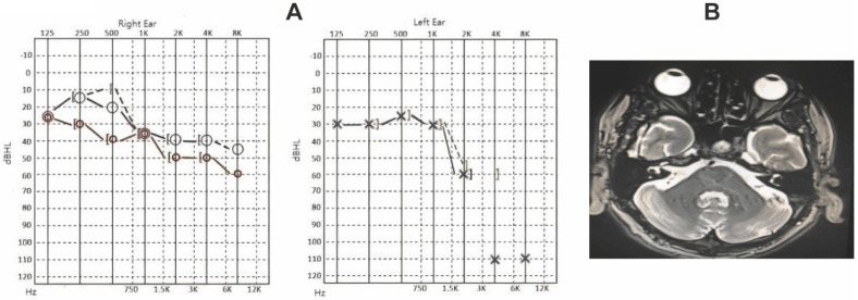 Investigating the Process of Autoimmune Inner Ear Disease: Unveiling ...