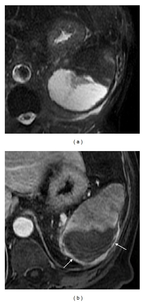 The Spleen Revisited: An Overview on Magnetic Resonance Imaging - PMC