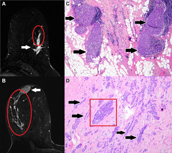 Examples of malignant mass-associated nonmass enhancement (NME): Axial breast MR images (left) of malignant mass-associated NME (red oval) and corresponding pathology slides (right). (A, C) Mass-associated NME that was MRI-guided biopsy–proven ductal carcinoma in situ (DCIS) in a 62-year-old woman with newly diagnosed invasive ductal carcinoma. Axial postcontrast T1-weighted subtraction image (A) demonstrates a 2.2-cm heterogeneous NME in a linear distribution extending from a 2.0-cm irregular heterogeneous mass with spiculated margins in the lower outer left breast. Histologic view of the mass-associated NME shows dilated ducts that are distended and filled by a solid proliferation of tumor cells (black arrows in C), compatible with DCIS. (Hematoxylin-eosin stain; original magnification, ×40.) (B, D) Mass-associated NME that was lumpectomy-proven invasive lobular carcinoma and lobular carcinoma in situ in a 43-year-old woman with newly diagnosed invasive lobular carcinoma. Axial postcontrast T1-weighted subtraction image (B) demonstrates a 10.0-cm clumped NME in a segmental distribution extending from a 2.3-cm oval heterogeneous mass with irregular margins in the upper outer right breast. Histologic view of mass-associated NME shows a dilated duct filled by an intraductal proliferation of monotonous loosely cohesive cells (red box in D), compatible with lobular carcinoma in situ, and infiltrative proliferation of mildly atypical cells arranged in single files, cords, and single cells in a desmoplastic stroma (black arrows in D), compatible with invasive lobular carcinoma. (Hematoxylin-eosin stain; original magnification, ×100.)