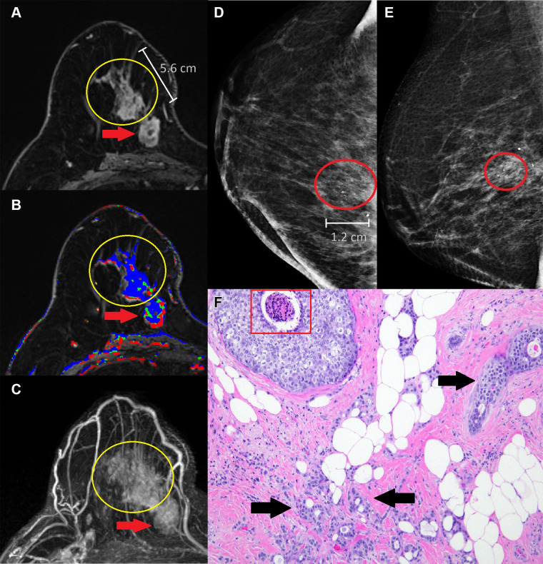 Mass-associated nonmass enhancement (NME) that was mastectomy-proven invasive ductal carcinoma (IDC) and ductal carcinoma in situ (DCIS) in a 58-year-old woman with newly diagnosed IDC. (A) Axial postcontrast T1-weighted subtraction image demonstrates a 5.6-cm heterogeneous NME in a segmental distribution (yellow circle) with predominantly persistent kinetics (B) extending from a 2.7-cm irregular heterogeneous mass with irregular margins (red arrow) with predominantly washout kinetics in the lower inner right breast. (C) Maximum intensity projection image demonstrates the mass-associated NME (yellow circle) extending from the malignant index mass (red arrow) in the lower inner right breast. (D) Full craniocaudal and (E) mediolateral oblique views demonstrate 1.2-cm amorphous calcifications in a segmental distribution (red oval) that correlate with the mass-associated NME observed at breast MRI. (F) Histologic view of the mass-associated NME shows atypical epithelial cells with comedonecrosis (red box), compatible with DCIS, and infiltrative glandular proliferation with minimal cytologic atypia and desmoplastic stromal response (black arrows), compatible with IDC. (Hematoxylin-eosin stain; original magnification, ×100.)