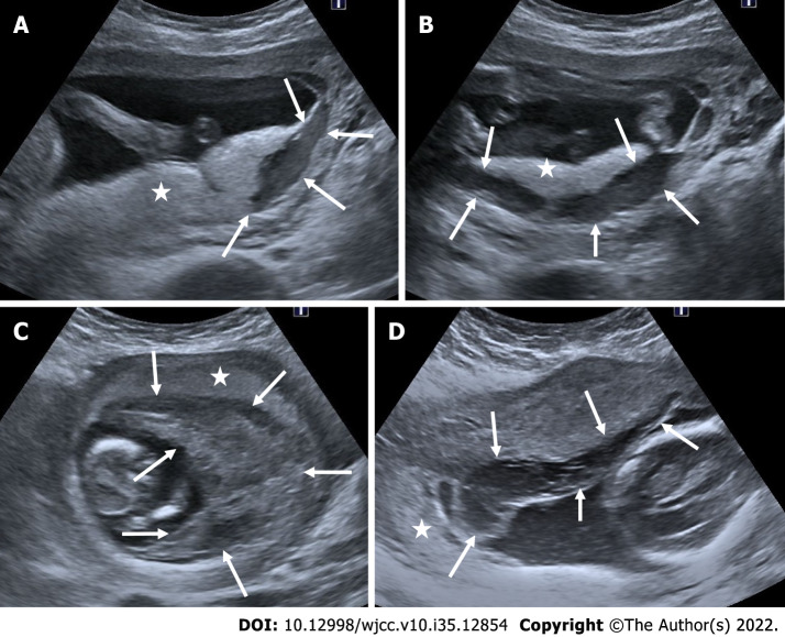 Antenatal imaging: A pictorial review - PMC