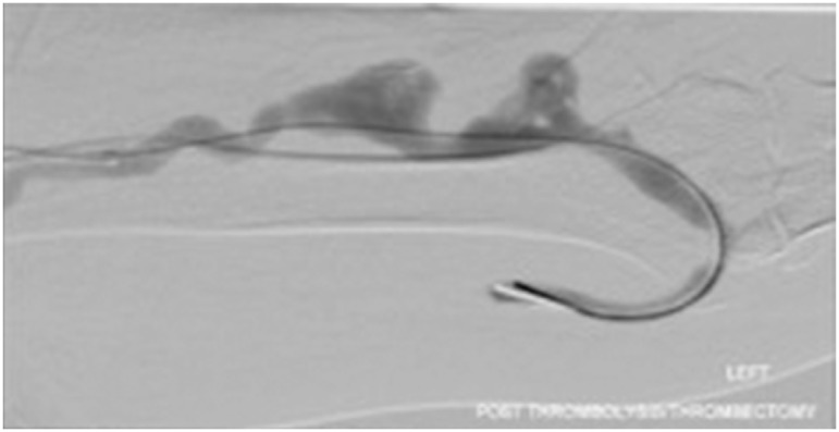Fig. 3 The appearance of an aneurysmal segment of arteriovenous fistula after applying Cleaner XT™.