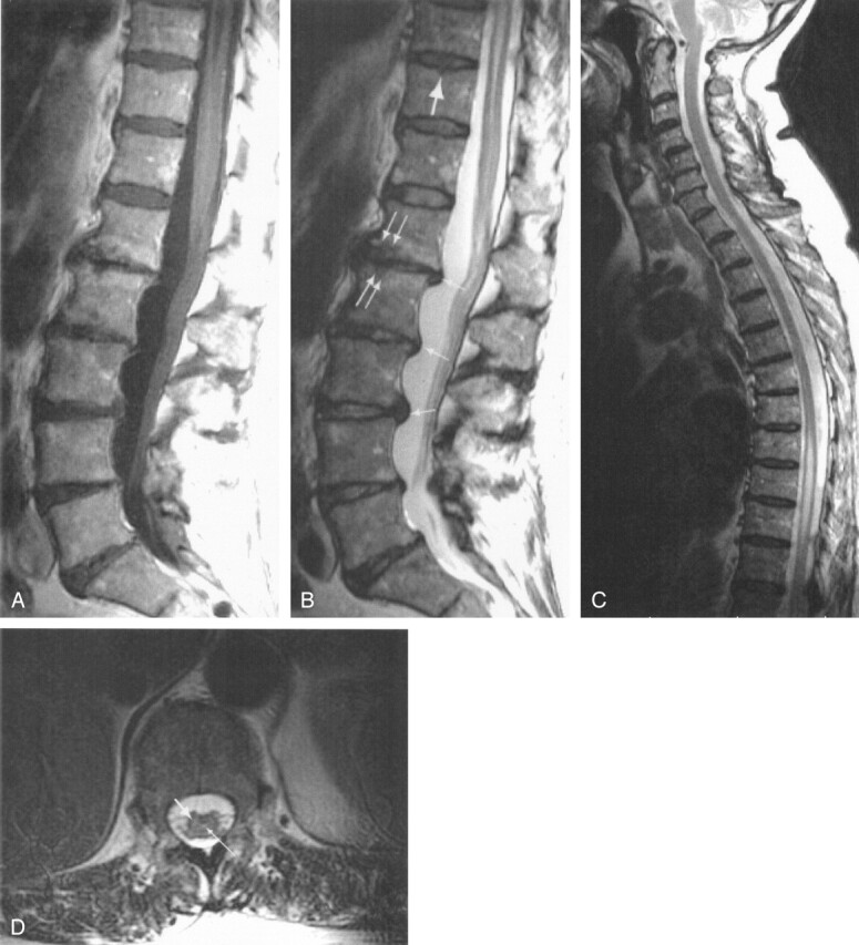 Fibrocartilaginous Embolization to the Spinal Cord: Serial MR Imaging ...