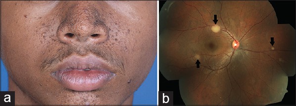 Retinal Astrocytic Hamartoma in Tuberous Sclerosis - PMC