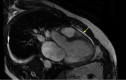 CMR with diffuse late gadolinium enhancement shows myocardial scarring