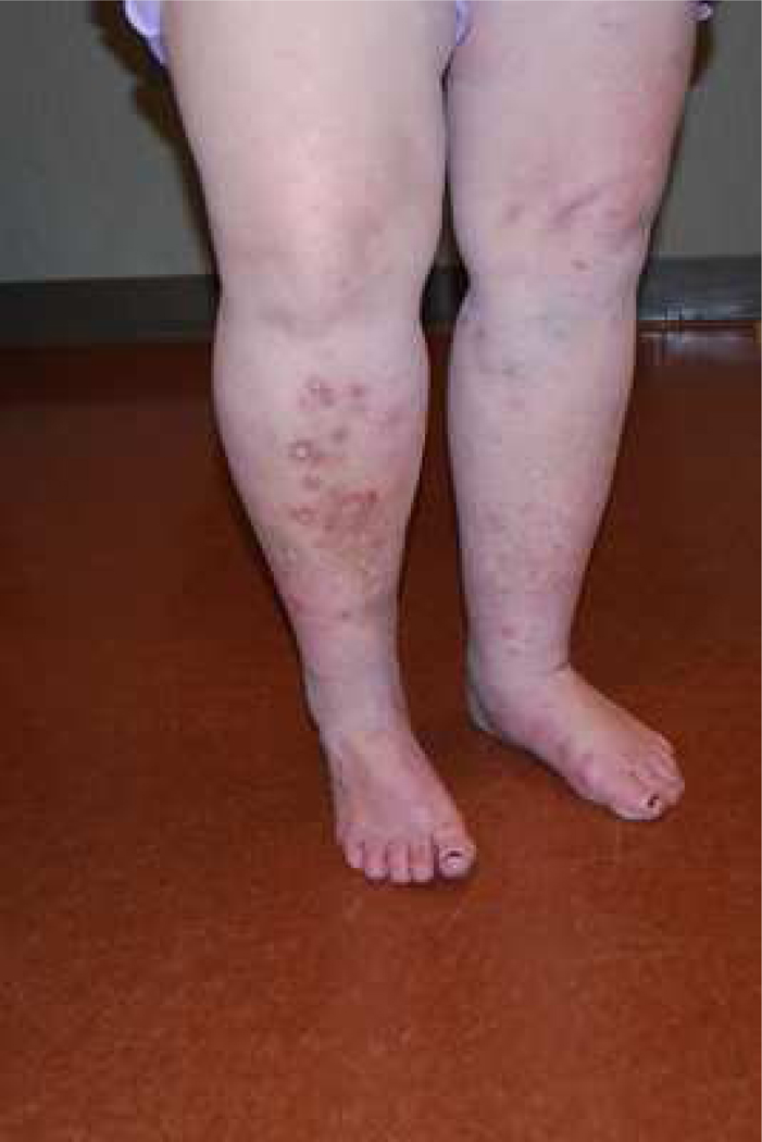 gabapentin for neuropathic itch