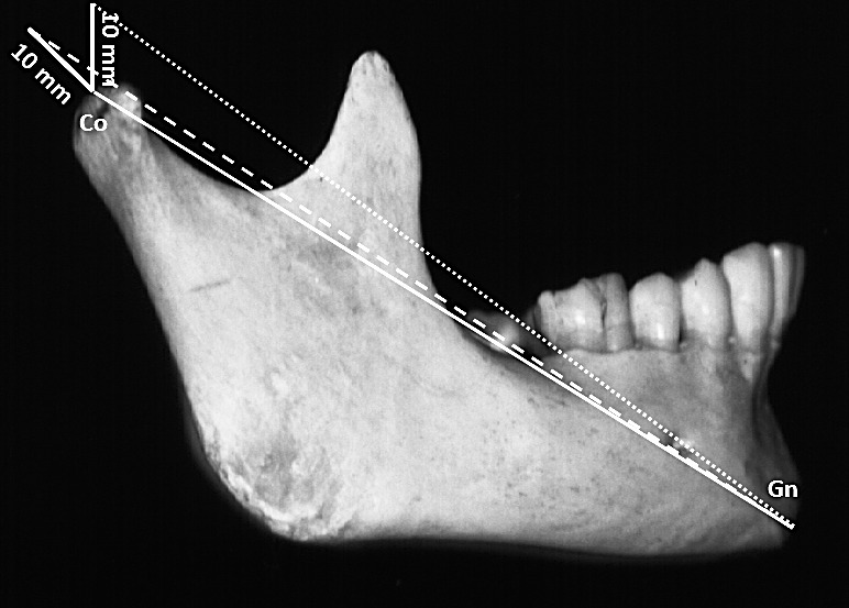 Figure 1. Same amounts (10 mm) of condylar growth (continuous lines) produce differences in total mandibular length (CoGn), depending on the growth direction. Initial CoGn (100 mm) (continuous line) increased to approximately 106 mm with vertical condylar growth (dotted line) and to approximately 110 mm with posterior condylar growth (dashed line).