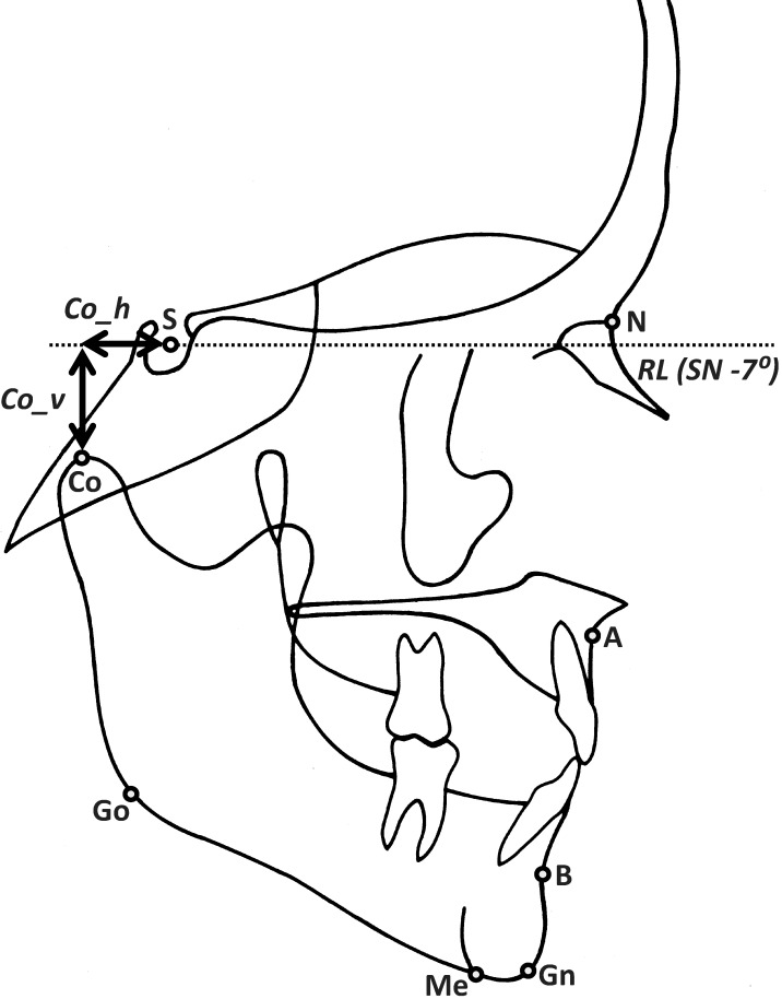 Figure 2. Cephalometric landmarks digitized: (S) sella, (N) nasion, (Co) condylion, (Go) gonion, (Me) menton, (A) A-point, and (B) B-point. Horizontal and vertical measurements were obtained by registering on sella (S) and orienting on SN −7°.